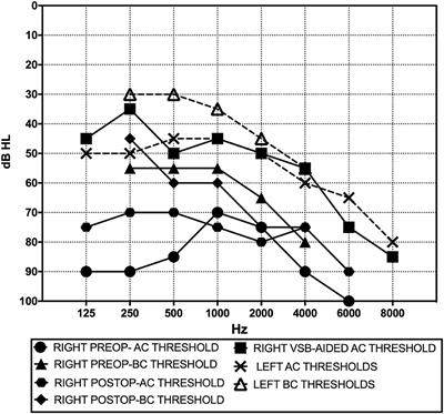 Case Report: Local Anesthesia Round Window Plugging and Simultaneous Vibrant Soundbridge Implant for Superior Semicircular Canal Dehiscence